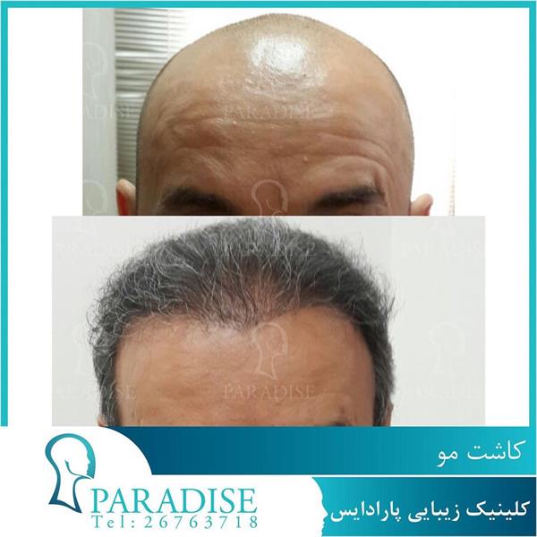 تصاویر قبل و بعد از کاشت مو