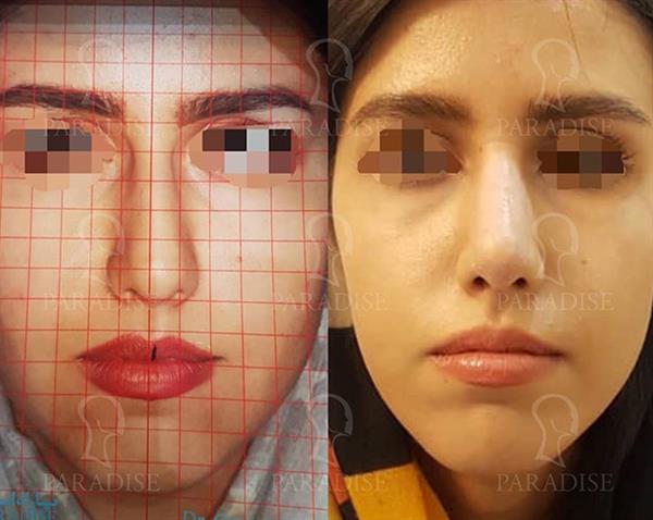 عکس قبل و بعد از عمل تیپ پلاستی دکتر هومن گنجه خسروی