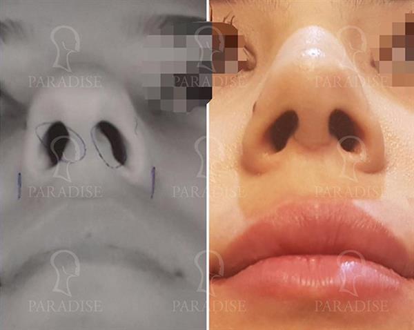 عکس قبل و بعد از عمل رینو پلاستی دکتر هومن گنجه خسروی