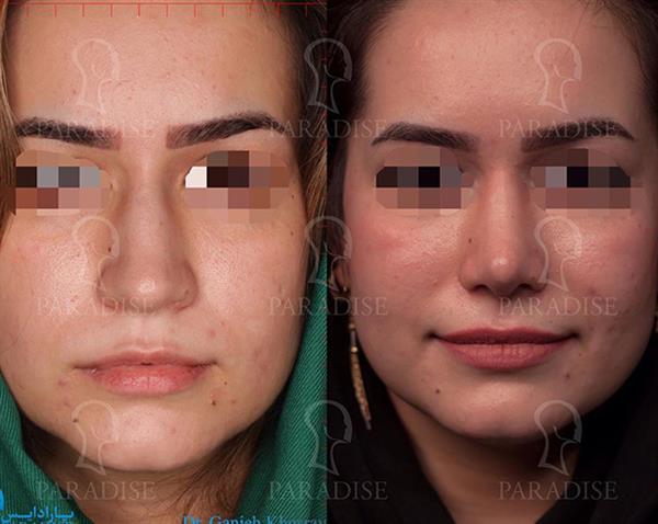 عکس قبل و بعد از عمل تیپ پلاستی دکتر هومن گنجه خسروی