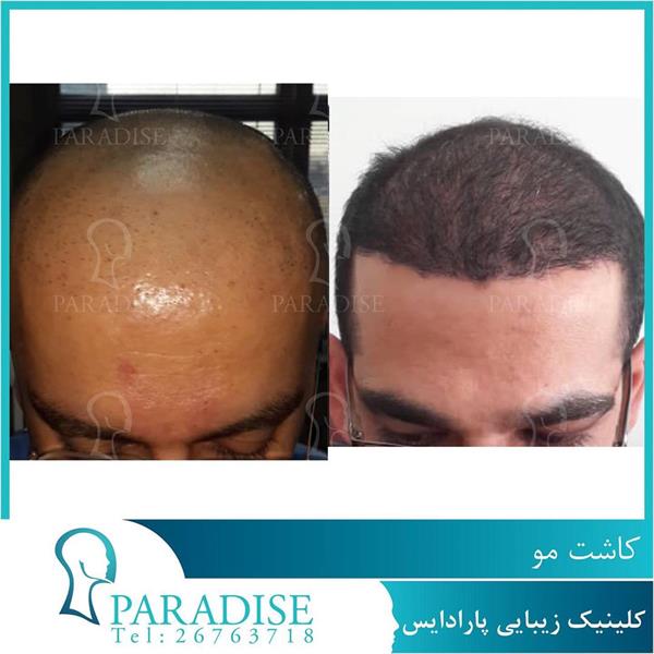 تصاویر قبل و بعد از کاشت مو